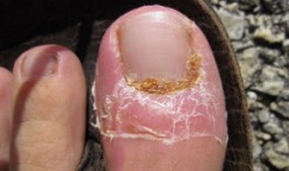 Treatment of nail fungus