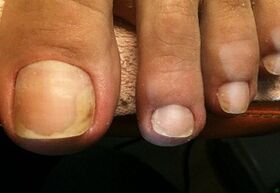 Fungus on the big toe