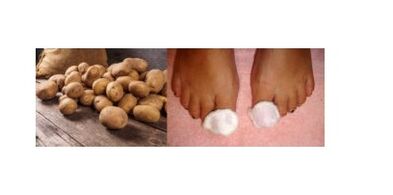 potatoes for nail fungus