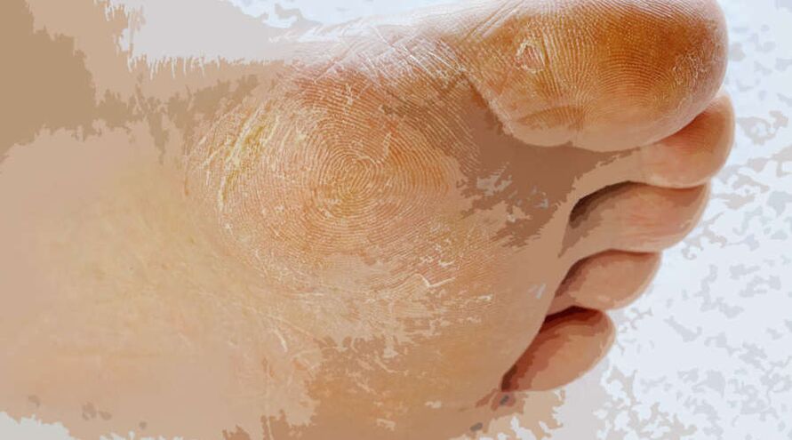 Mycosis of the foot