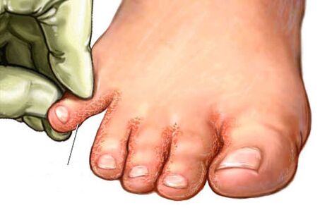 fungus between toes