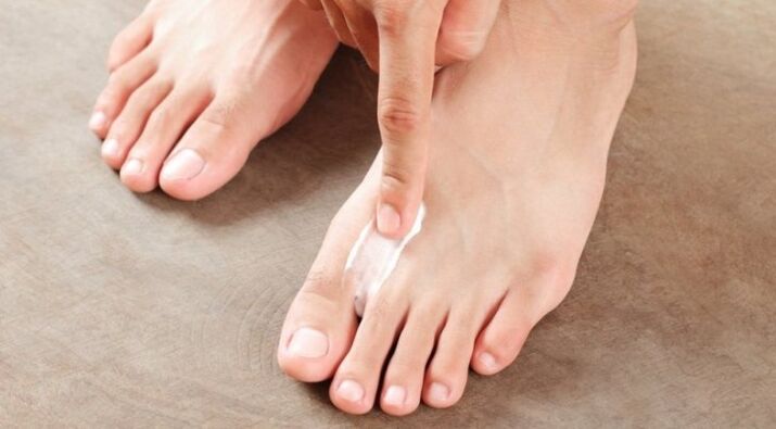 how and how to treat the fungus between the toes