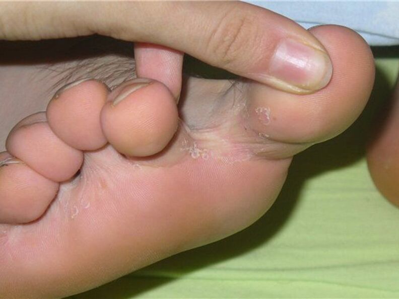 fungus between toes photo 1