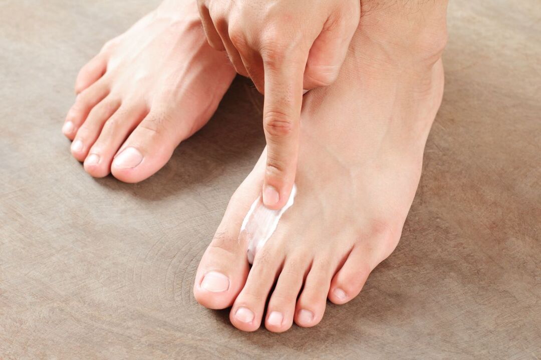 treatment of fungus on the feet with ointment