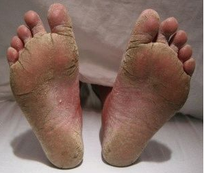 foot fungus looks like