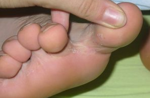 Fungus between toes