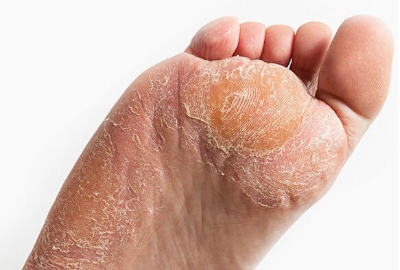 peeling of the skin when infected with a fungus