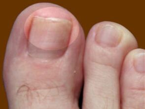 Toenail fungus - an indication for the use of fungicidal drops