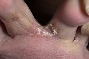 skin fungus between toes