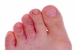 toe fungus symptoms