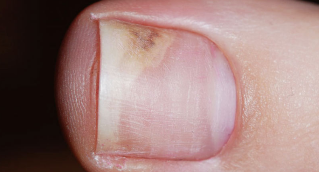 The symptoms of the initial stages of onychomycosis
