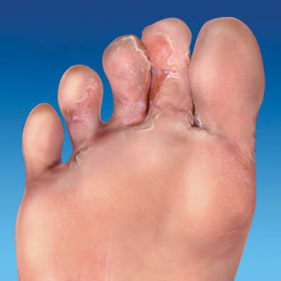 skin fungus feet