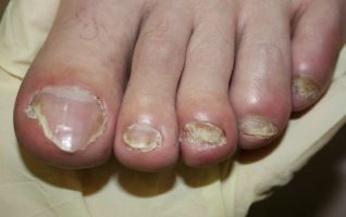 the symptoms of nail fungus