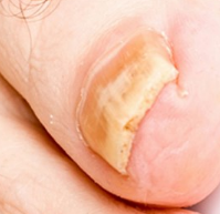 The nail affected by the fungus